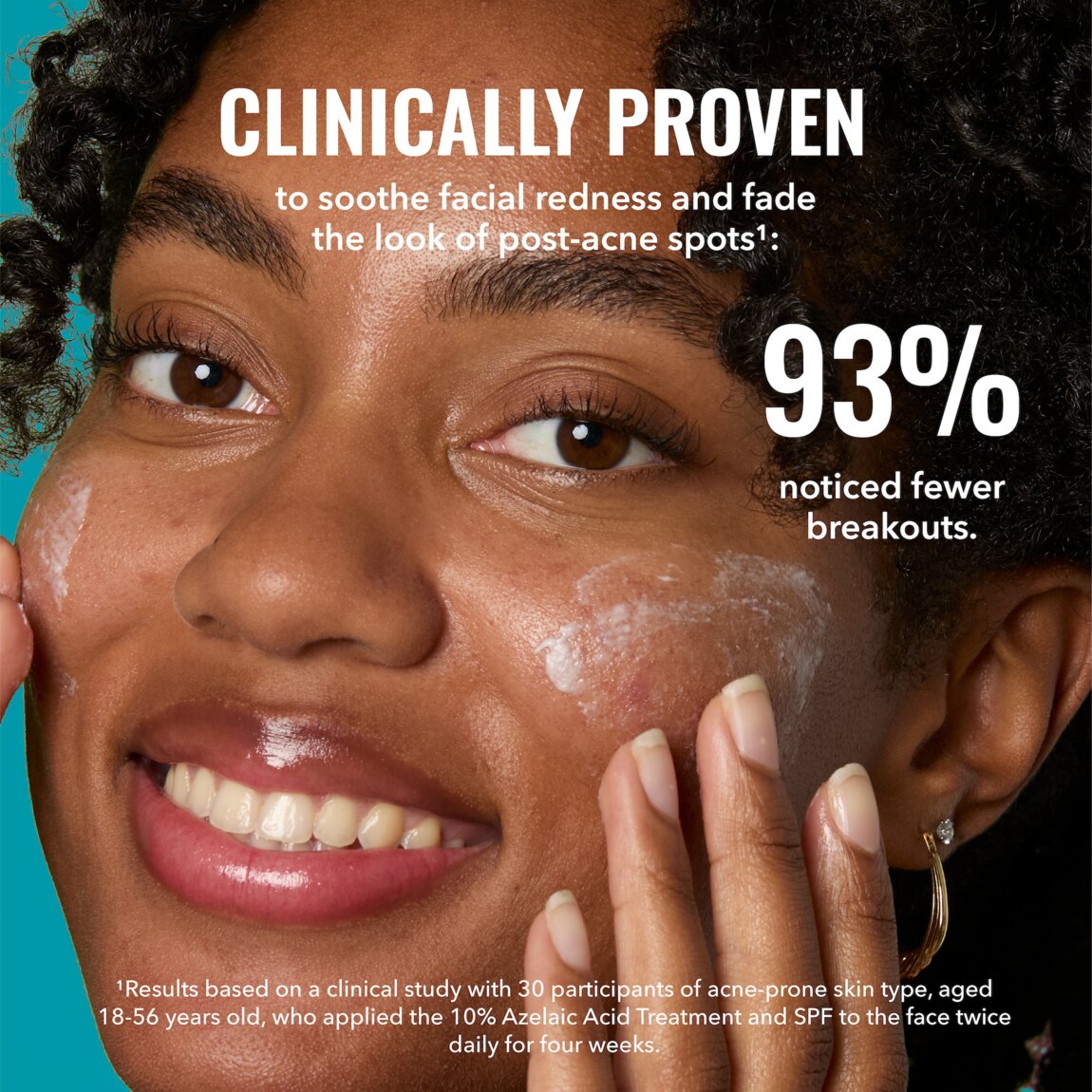 10-azelaic-acid-treatment-r4 zb_p.jpg