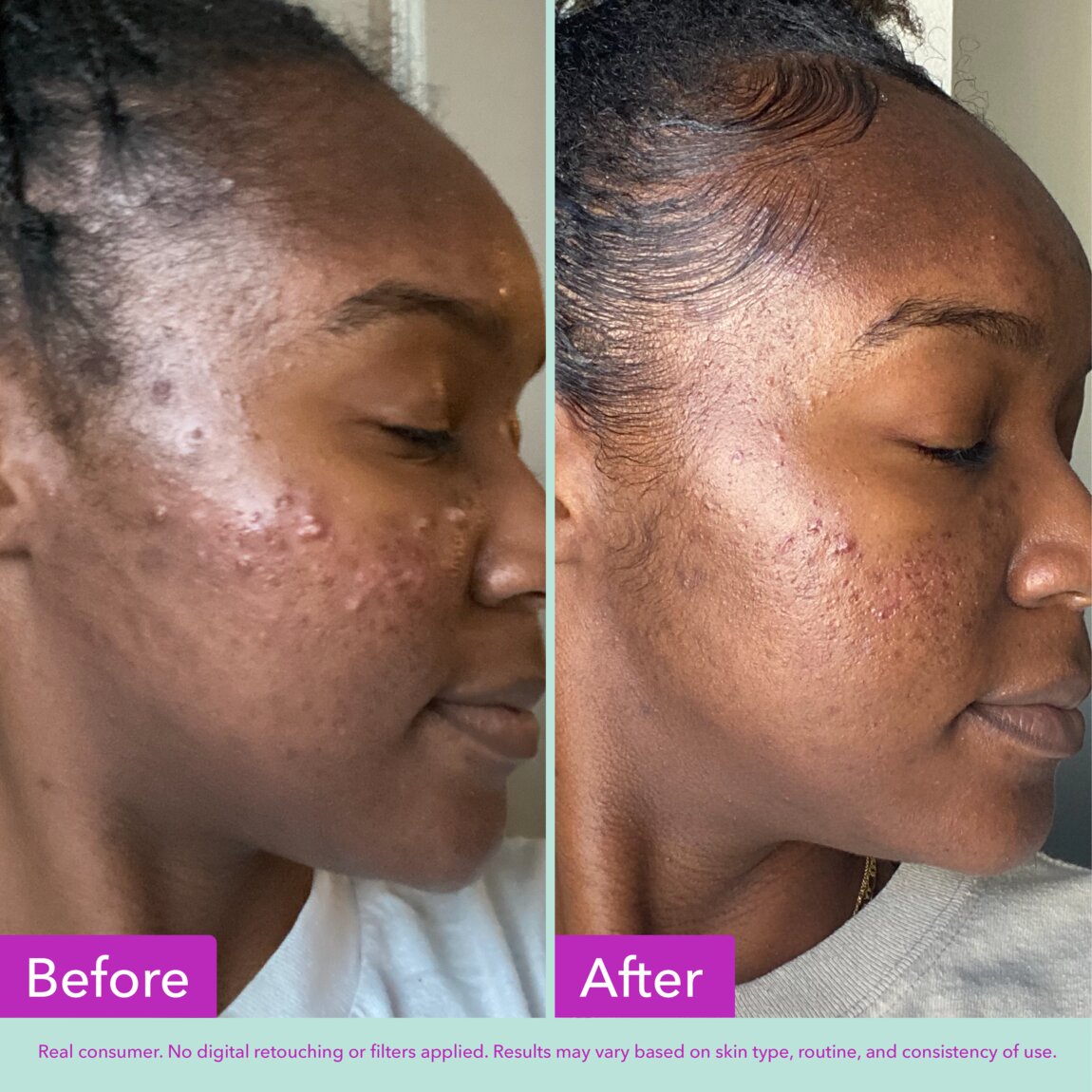 acne-foaming-cleanser-w4 zb_p.jpg